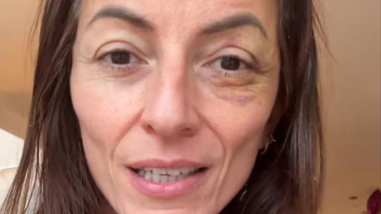 Davina McCall děkuje svým fanouškům na Instagramu "průběžná podpora" uprostřed jejího zotavení po operaci mozku.