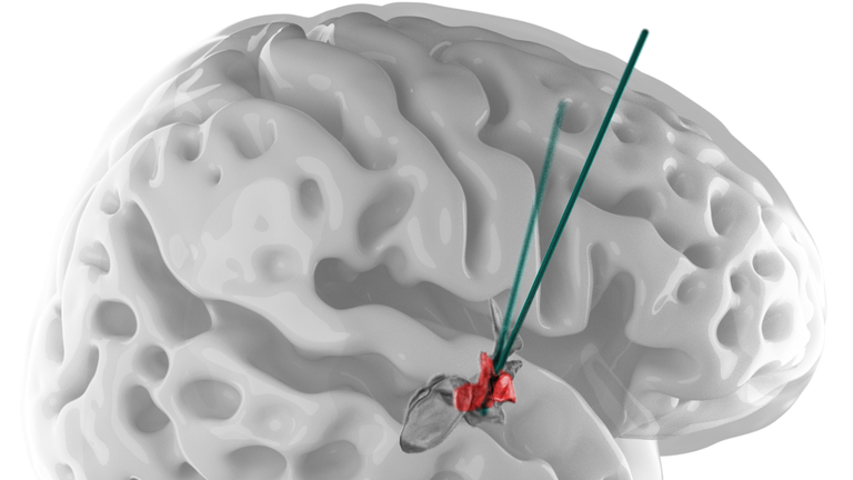 Vizuální znázornění hluboké mozkové stimulace laterálního hypotalamu. Obrázek: NeuroRestore/EPFL 2024