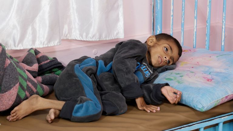 Palestinský chlapec Usáma Al-Reqep, 5 let, leží na posteli v nemocnici Nasser v Khan Younis, v jižní gaze. Pic: Reuters