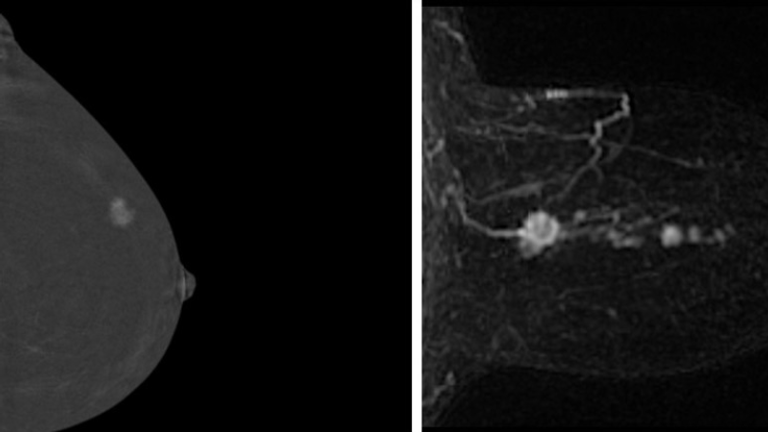 Skenování prsu pomocí CEM (vlevo) a AB-MRI (vpravo) ukazují nádory, které nejsou na mamogramech vidět. Pic: Cambridge University Hospitals NHS Foundation Trust