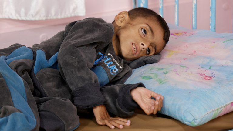 Palestinský chlapec Usáma Al-Reqep, 5, leží na posteli v Nasser Hospital, kde dostává léčbu v Khan Younis, v jižním pásmu Gazy, 1. května 2025. Reuters/Hatem Khaled