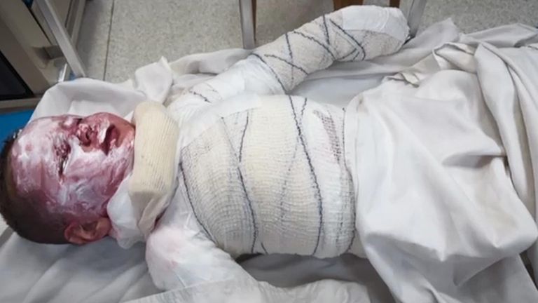Haitum, tříletá palestinská léčba Dr. Victoria Rose