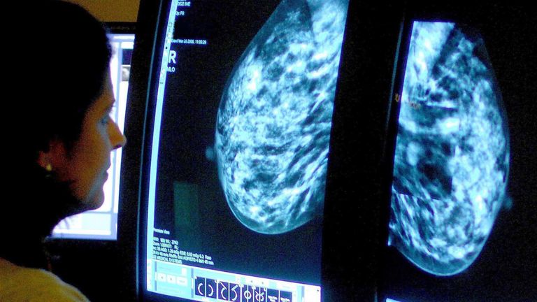 Embargoed na 0001 úterý 26. března SOUBOR PŘIPOMÍNA DETORTY 15/06/06 konzultanta analyzujícího mamogram. Vědci zjistili, jak se mohou buňky rakoviny prsu vyhnout léčbě "hibernace" a pak "probudit se" O několik let později - způsobující relaps, který je obtížnější léčit. Vědci z Institutu výzkumu rakoviny v Londýně odhalili mechanismus, kterým se hormonální léčba používala k zabránění vracet rakoviny prsu v některých rakovinných buňkách, což je způsobilo "Hiberna