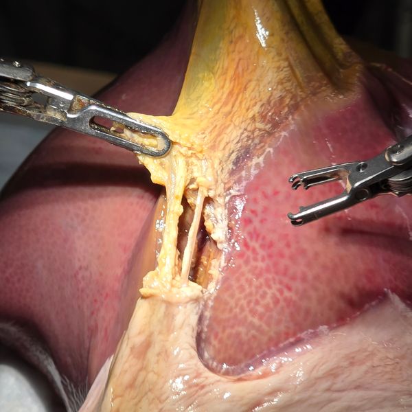 Všimněte si, že grafický obsah embargoval do roku 1900 Středa 9. července Nedatovaná letáková fotografie vydaná Johns Hopkins University of Surgical Robot Transform