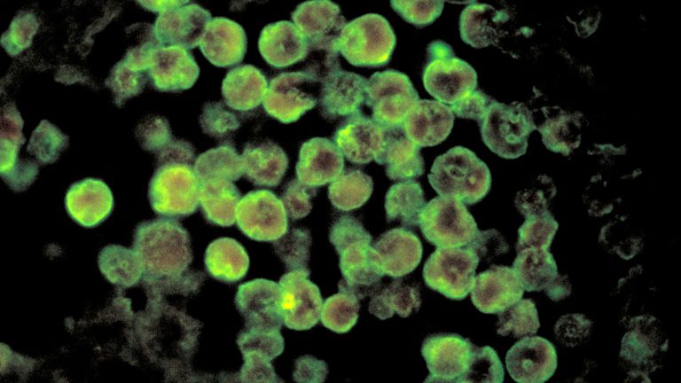 Fotomikrograf podání poskytovaného Centry pro kontrolu a prevenci nemocí (CDC) zobrazuje charakteristiky spojené s případem primární amébické meningoencefalitidy, vzácnou mozkovou infekci způsobenou parazity Naegleria fowleri, amoeba konzumující mozek, konzumující mozek, konzumující mozek, konzumující mozek, konzumující mozek