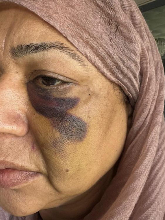 Obrázek ukazující zranění údajně přijato Shameem Akhtarem, 56, během incidentu na letišti v Manchesteru
