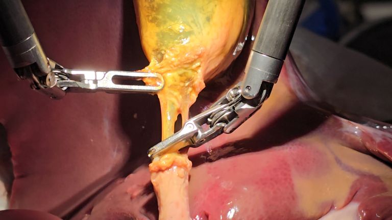 Všimněte si, že grafický obsah embargoval do roku 1900 Středa 9. července Nedatovaná letáková fotografie vydaná Johns Hopkins University of Surgical Robot Transform