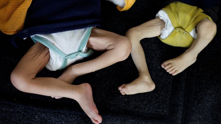 Nohy dvou podvyživených dětí v nemocnici v Rafahu. Pic: Reuters
